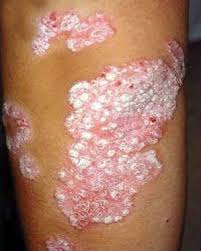 Psoriasis 2