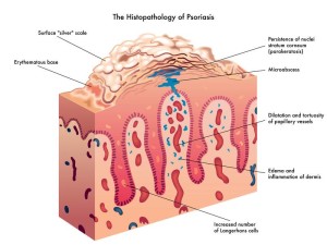 psoriasis 1